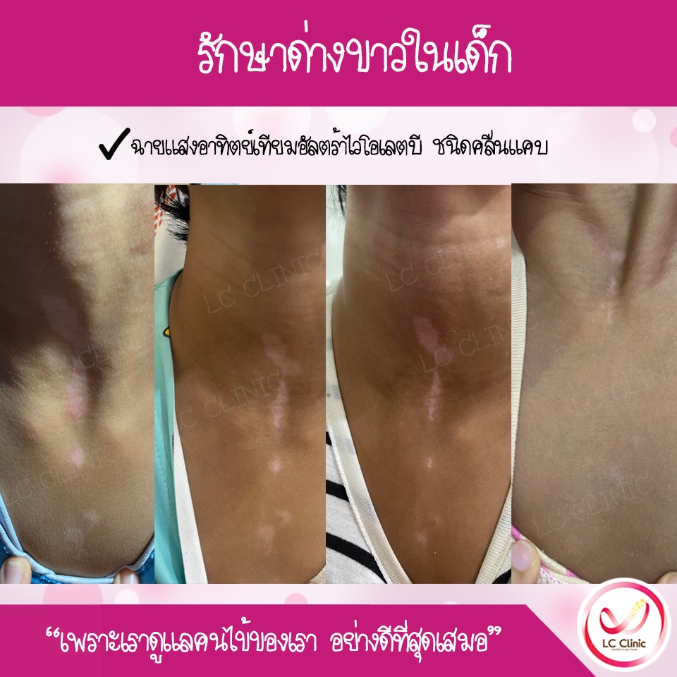 รักษา ด่างขาว โรคด่างขาว vitiligo ทำยังไง ตรวจเลือด ยากิน ยาทา ฉายแสง