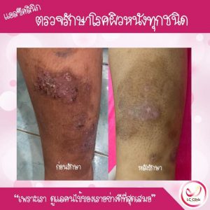 โรคผิวหนังอักเสบ เรื้อรัง โรคผื่นแพ้สัมผัส (Allergic Contact Dermatitis) คืออะไร สาเหตุ อาการ การรักษา