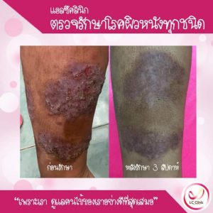 ผิวหนังอักเสบ Eczema คืออะไร สาเหตุ อาการ การวินิจฉัย การรักษา