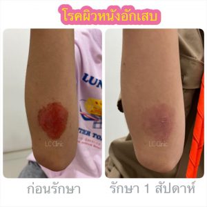 ผิวหนังอักเสบ Eczema คืออะไร สาเหตุ อาการ การวินิจฉัย การรักษา