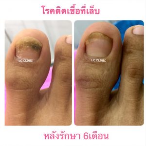 รักษา โรคเชื้อราที่เล็บ (Onychomycosis) สาเหตุ อาการ การรักษา การป้องกัน