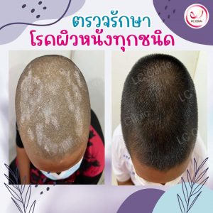 โรคกลาก เชื้อรา บนหนังศีรษะ Tinea Capitis สาเหตุ อาการ การรักษา