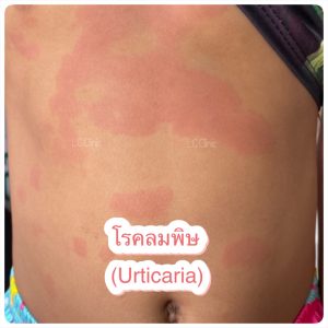 โรคลมพิษ Urticaria คืออะไร สาเหตุ อาการ การวินิจฉัย การรักษา ป้องกัน