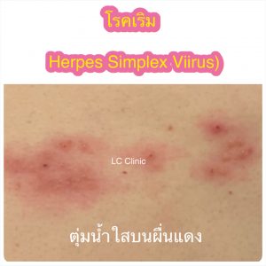 เริมเรื้อรัง เป็นเริมบ่อยมาก (Recurrent Herpes Simplex) รักษายังไง