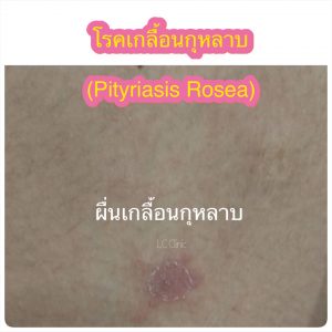 โรคผื่นขุยกุหลาบ เกลื้อนกุหลาบ คืออะไร สาเหตุ อาการ การรักษา