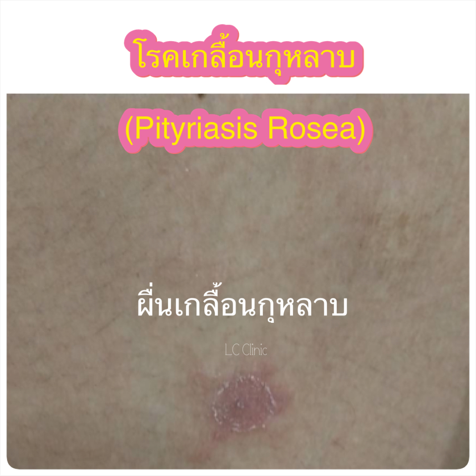 โรคผื่นขุยกุหลาบ เกลื้อนกุหลาบ คืออะไร สาเหตุ อาการ การรักษา