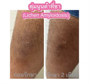 ตุ่มนูนคันที่ขา ตุ่มดำที่ขา โรคไลเค่นอะไมลอยโดซิส Lichen Amyloidosis