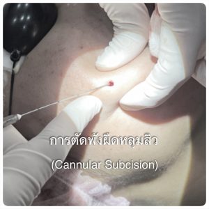 ตัดพังผืด รักษาหลุมสิว Subcision คืออะไร เหมาะกับใครบ้าง วิธีตัดพังผืดหลุมสิว