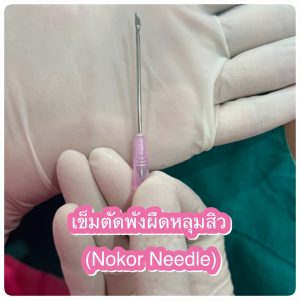 ตัดพังผืด รักษาหลุมสิว Subcision คืออะไร เหมาะกับใครบ้าง วิธีตัดพังผืดหลุมสิว