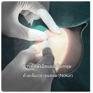 ตัดพังผืด รักษาหลุมสิว Subcision คืออะไร เหมาะกับใครบ้าง วิธีตัดพังผืดหลุมสิว