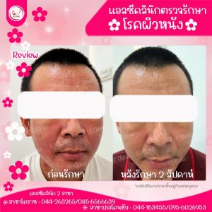 ต่อมไขมันโต Sebaceous Gland Hyperplasia ตุ่มนูนเหลือง ที่หน้า คืออะไร รักษายังไงดี