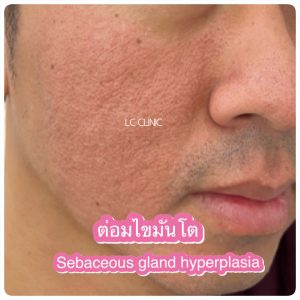 ต่อมไขมันโต Sebaceous Gland Hyperplasia ตุ่มนูนเหลือง ที่หน้า คืออะไร รักษายังไงดี