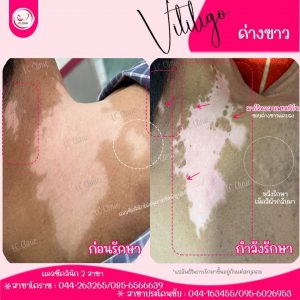 รักษา ด่างขาว โรคด่างขาว vitiligo ทำยังไง ตรวจเลือด ยากิน ยาทา ยาฉีด ฉายแสง