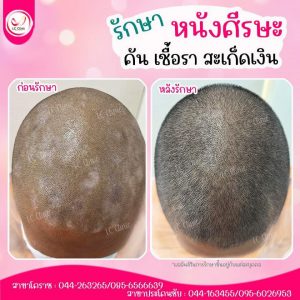 โรคหนังศีรษะ ติดเชื้อที่ศีรษะ ที่พบบ่อย โรคเซบเดิร์ม สะเก็ดเงินที่ศีรษะ รูขุมขนอักเสบ ติดเชื้อราที่ศีรษะ