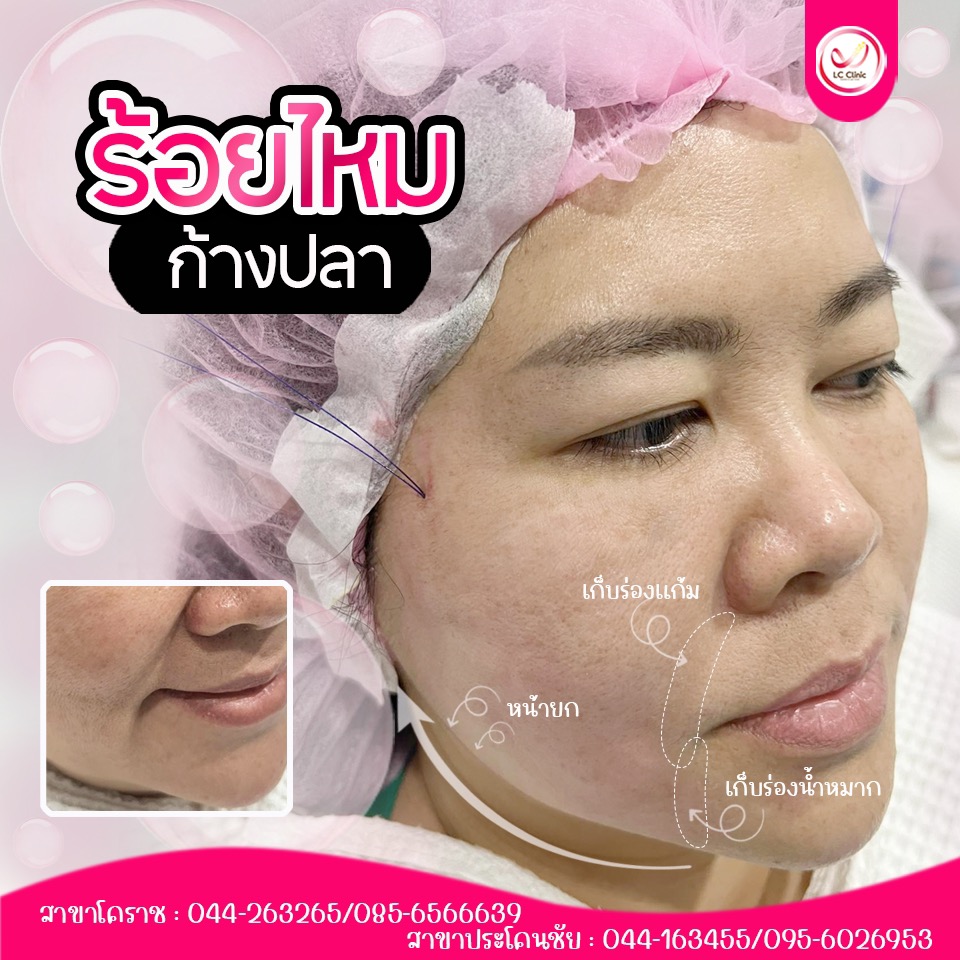 บทความความงาม เลเซอร์ สิว ฝ้า โบท็อก ฟิลเลอร์ ร้อยไหม