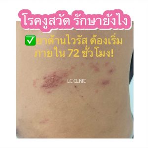งูสวัด รักษายังไง อาการ การรักษา ภาวะแทรกซ้อน การป้องกัน โรคงูสวัด
