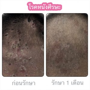 โรครูขุมขนอักเสบ โรคหนังศีรษะ ติดเชื้อที่ศีรษะ ที่พบบ่อย โรคเซบเดิร์ม สะเก็ดเงินที่ศีรษะ รูขุมขนอักเสบ ติดเชื้อราที่ศีรษะ