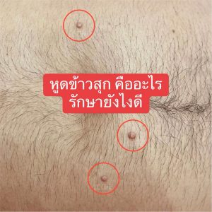 หูดข้าวสุก Molluscum Contagiosum คืออะไร สาเหตุ อาการ การติดต่อ การรักษา